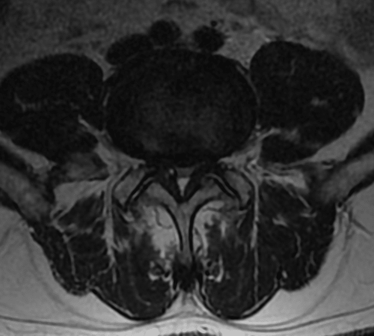 ciasnota kanału kręgowego
