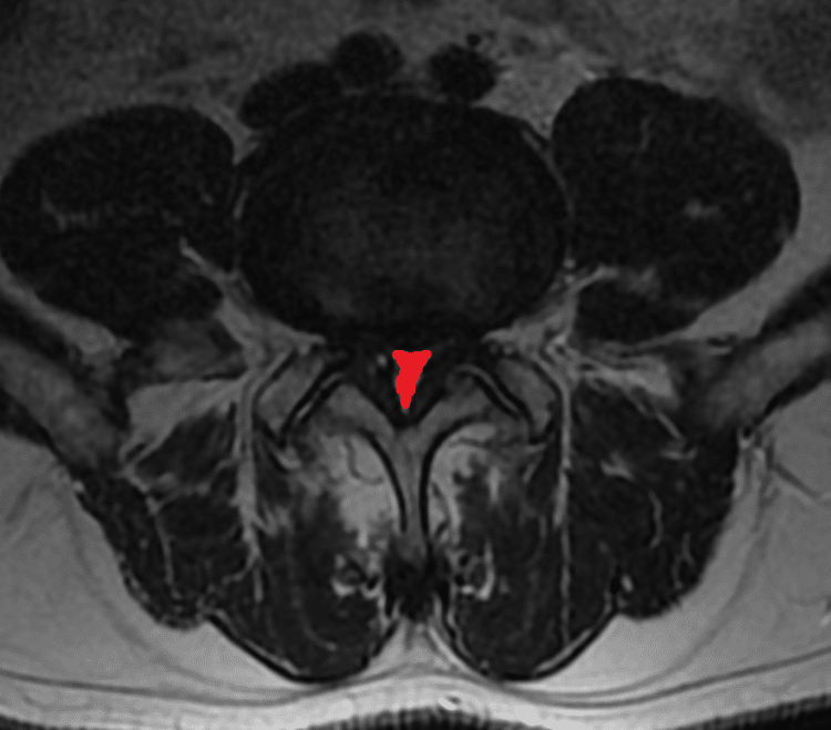 mocno zwężony kanał kręgowy