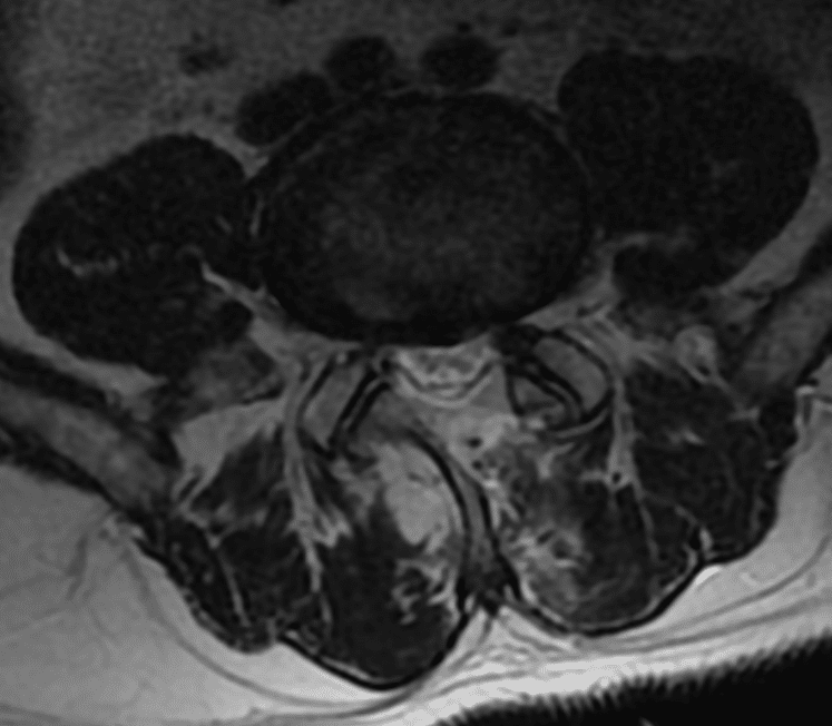 kanał kręgowy po odbarczeniu