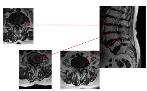 Wielopoziomowa stenoza w obrębie segmentu ruchowego L2/L3, L3/L4 i L4/L5