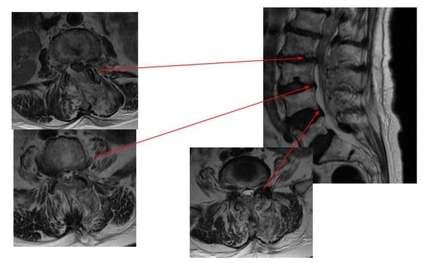 Endoskopowy zabieg w obrębie kręgosłupa lędźwiowego - odbarczenie na wielu poziomach